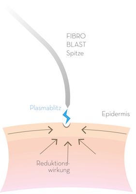 FibroBlast